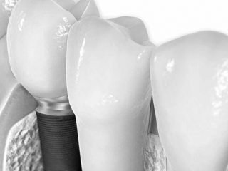 Verdades y mentiras de los implantes dentales