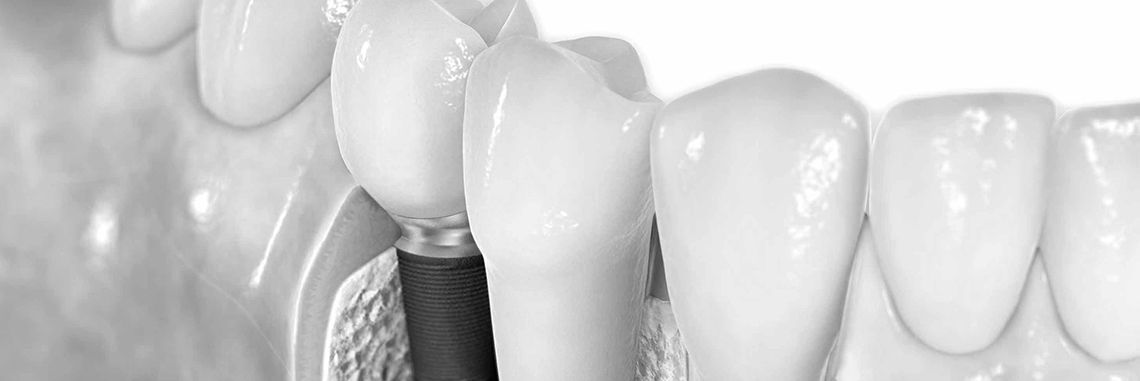 Verdades y mentiras de los implantes dentales